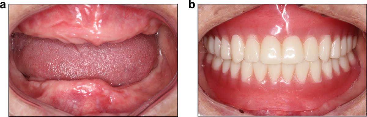 Complete Denture Treatment