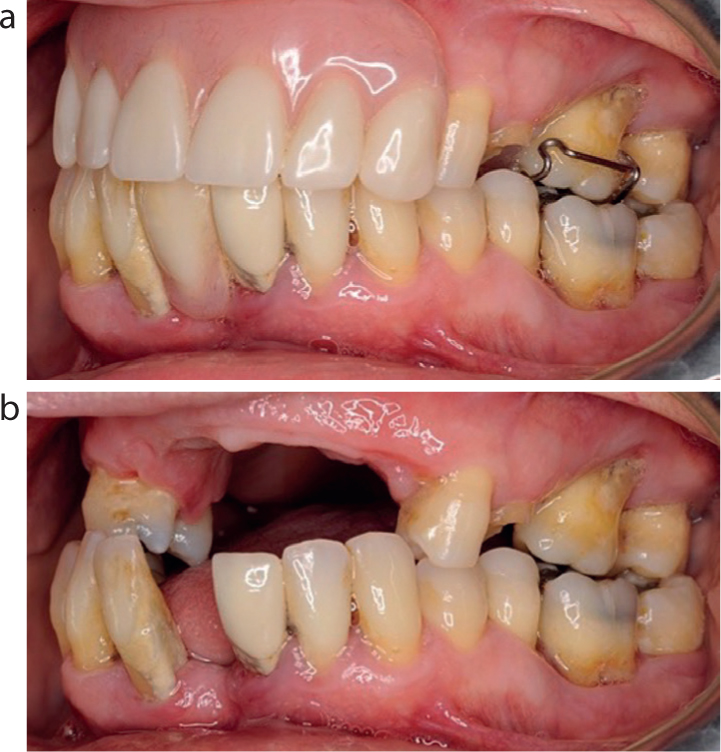 Partial Denture Treatment