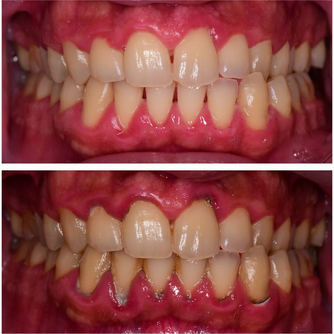 Scaling and Complete Oral Prophylaxis
