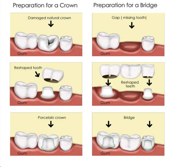 Crown & Bridge Procedure