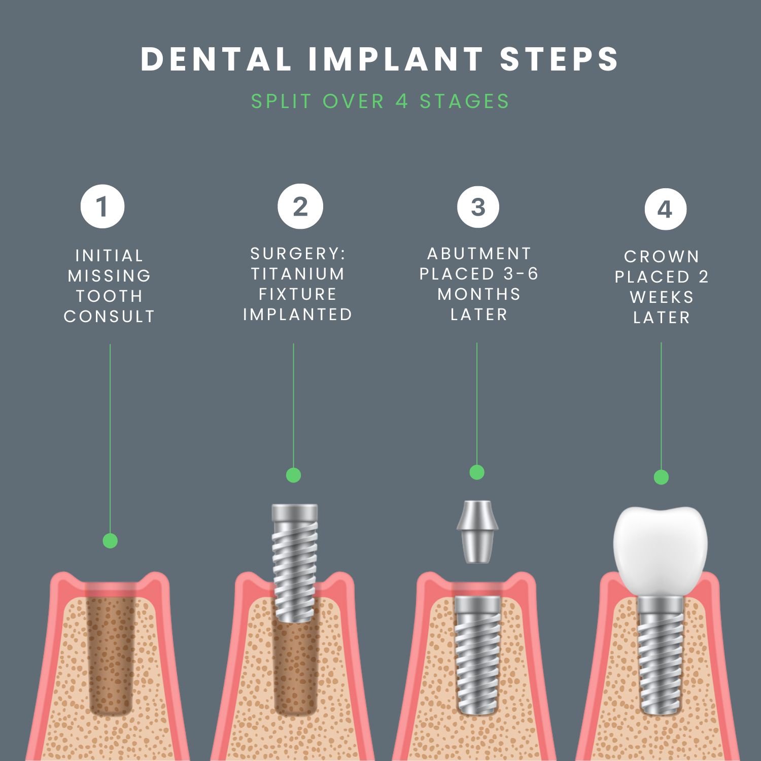 Dental Implant Procedure