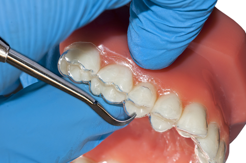 Invisalign Treatment Procedure