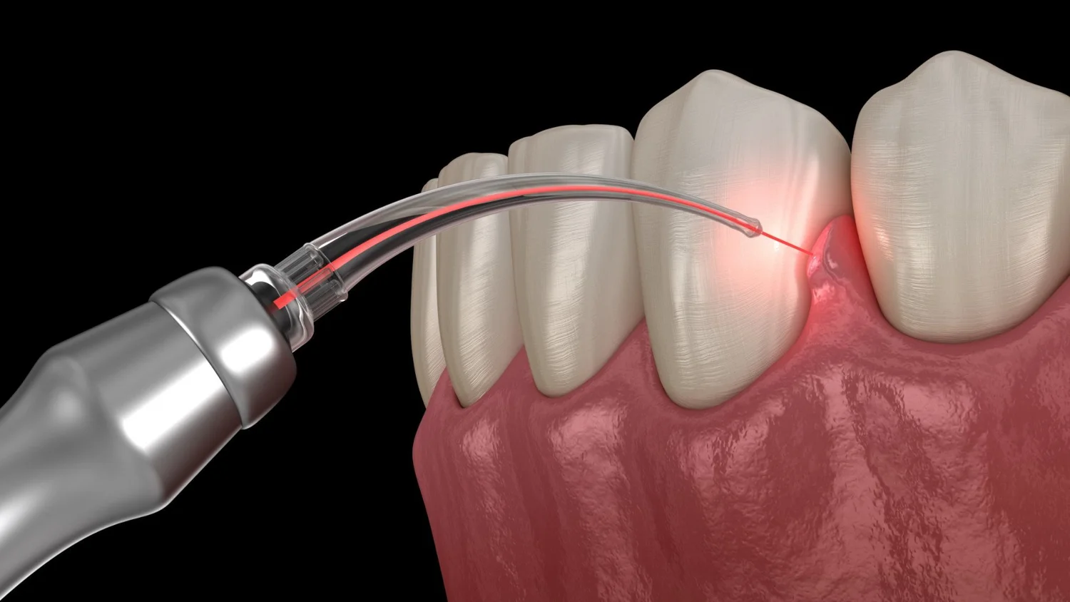 Laser Surgery Procedure