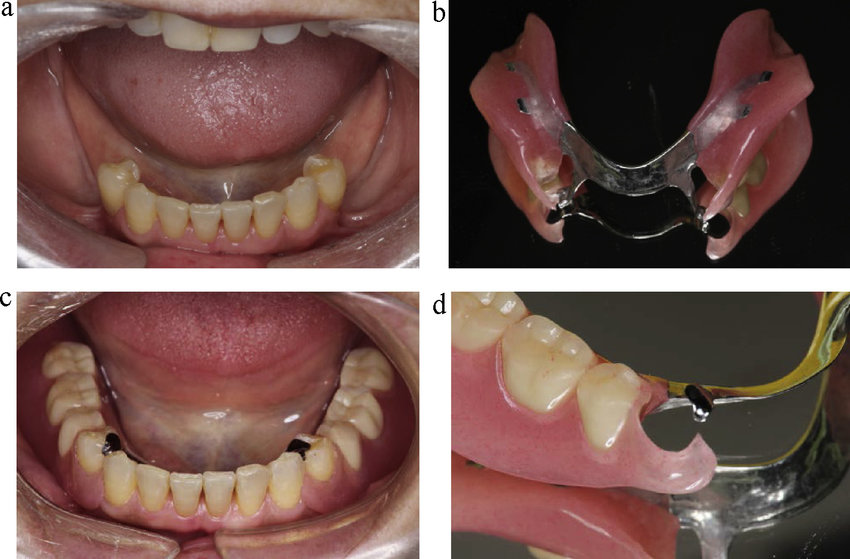 Denture Treatment Procedure