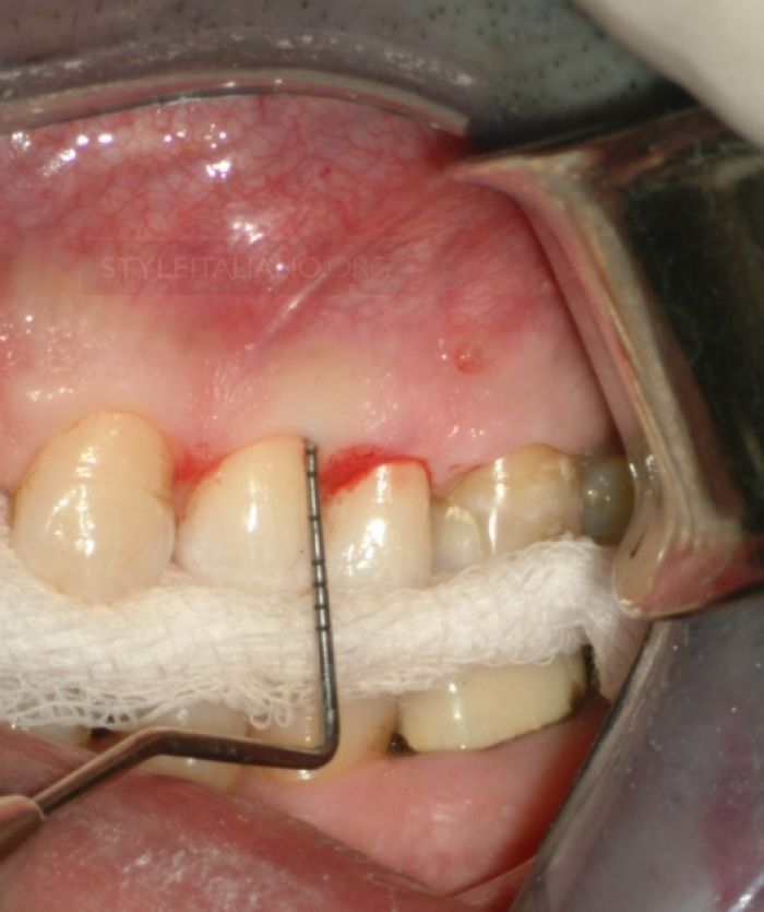Periapical Surgery Procedure