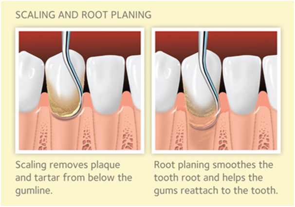 Root Planing Procedure