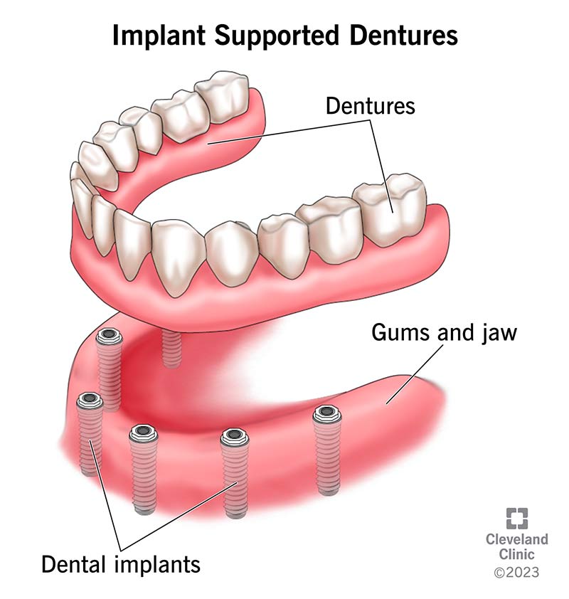 Implant-Supported Denture Procedure
