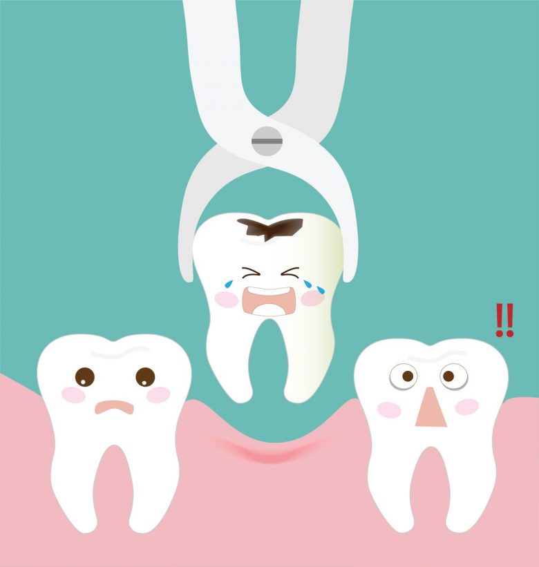 Teeth Extraction Procedure